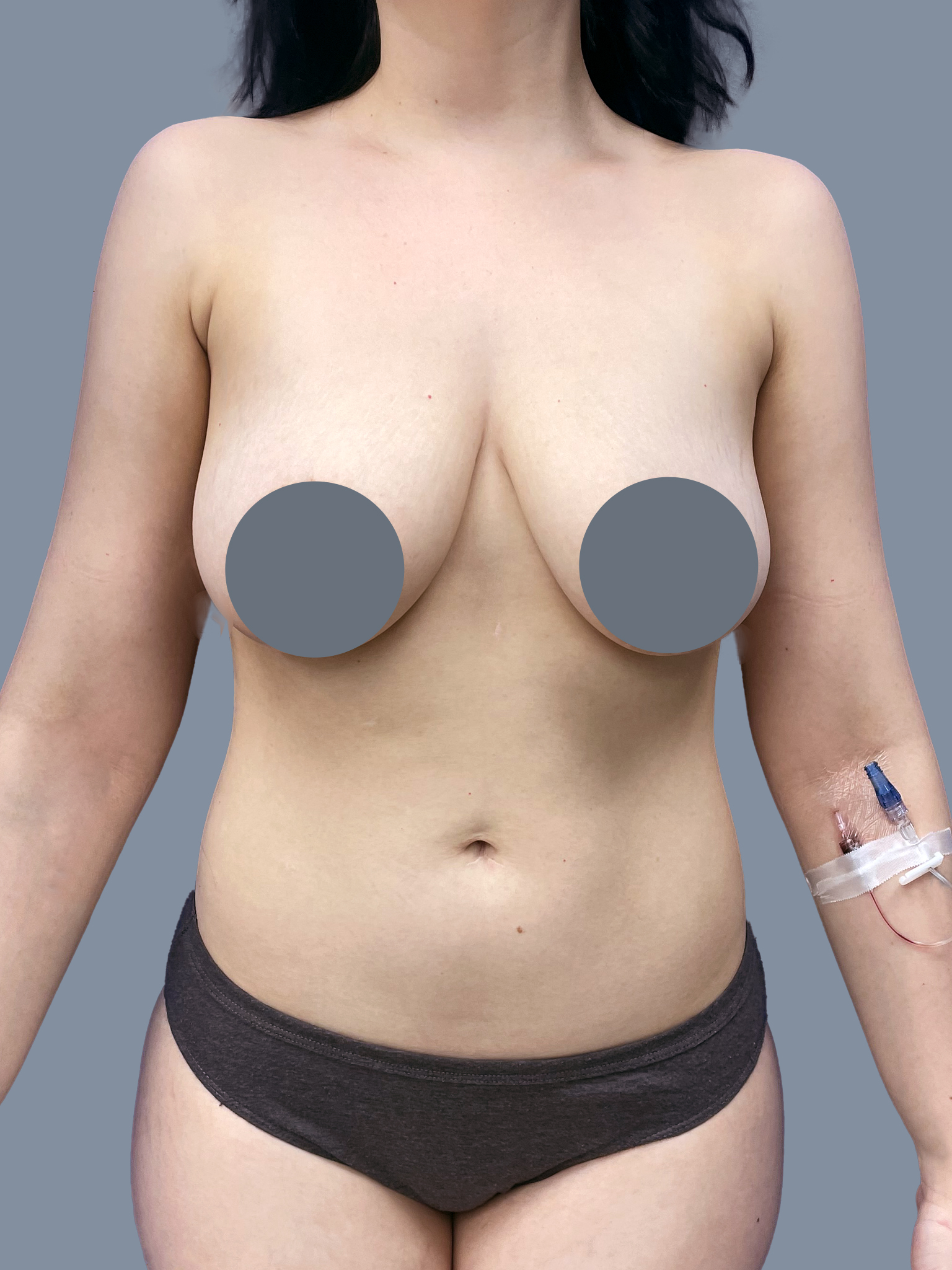 Case--7712-Breast-Lift---Augmentation | Before Breast