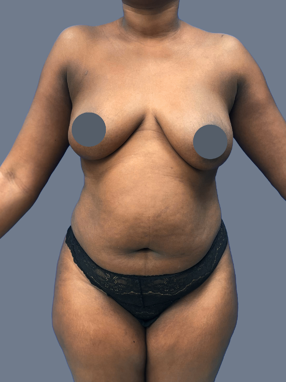 Case--5678-Breast-Lift---Augmentation | Before Breast