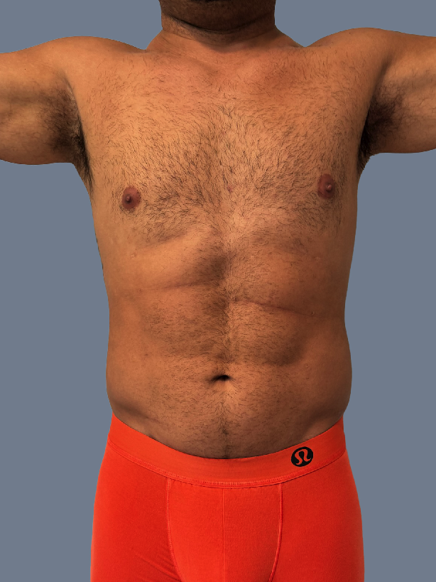 Case--2876-Male-High-Definition-Liposuction | After Male High Definition Liposuction