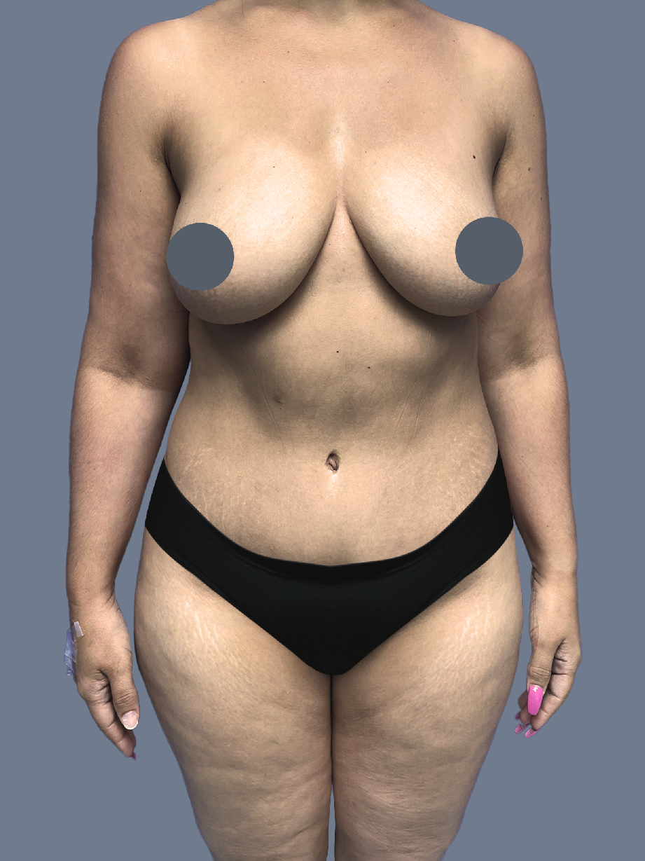 Case--9376-Lipo-360---8211--Thighs | Before Lipo 360 - Thighs