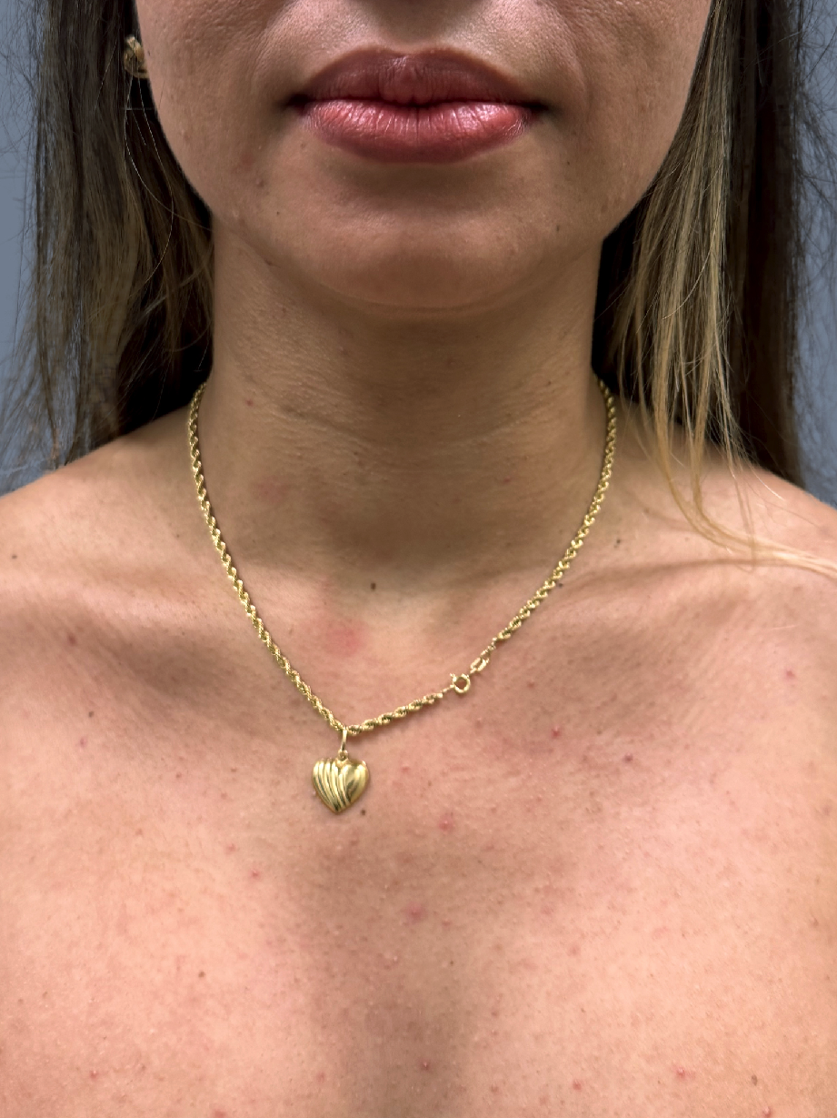 Case--7832-Chin-Liposuction | After Face