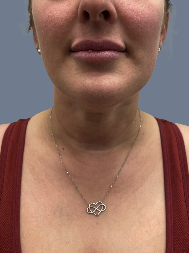 Case--9723-Chin-Liposuction | After Face