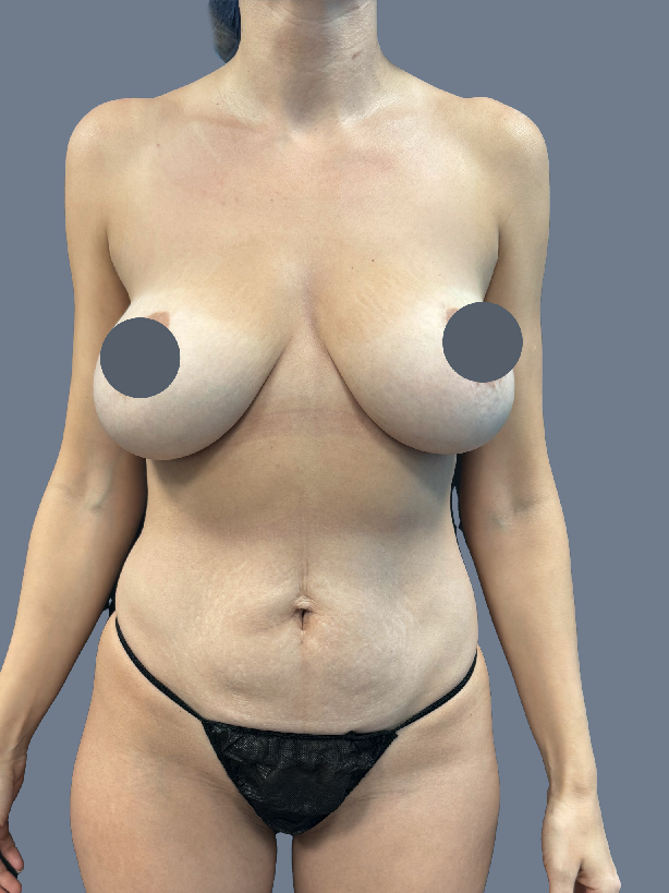 Case--1326-Lipo-360---8211--Tummy-Tuck-and-Breast-Augmentation-with-Lift | Before Lipo 360 - Brazilian Butt Lift