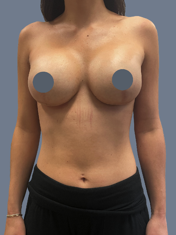 Case--8500-Breast-Augmentation | After Breast