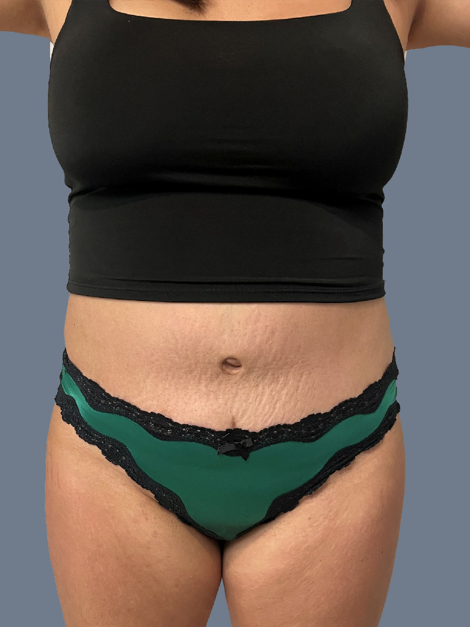 Case--5812-Lipo-360---8211--Brazilian-Butt-Lift | Before Lipo 360 - Brazilian Butt Lift