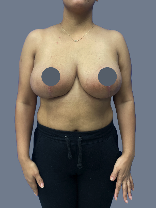 Case--5571-Breast-Lift-with-Reduction | After Breast