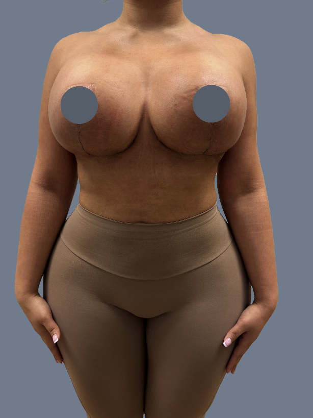 Case--7065-Breast-Revision | After Breast