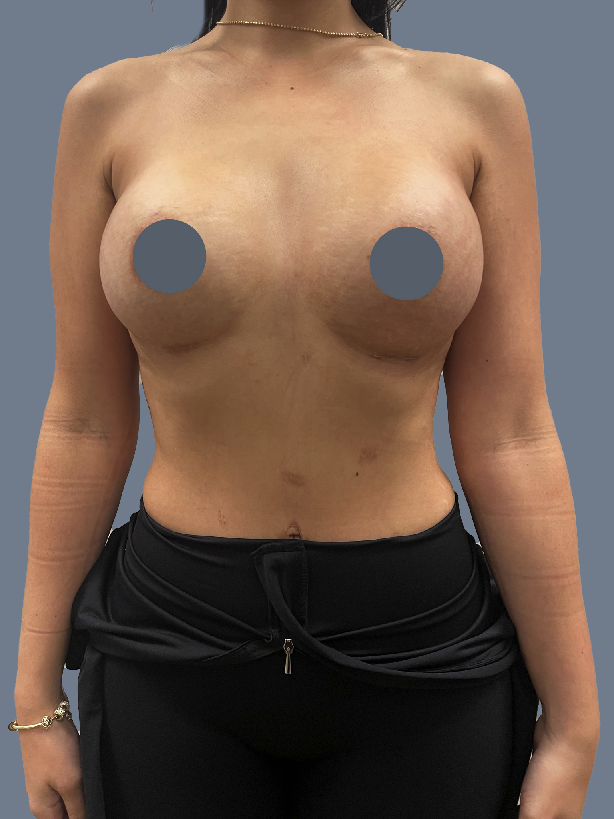 Case--2332-Breast-Augmentation | After Breast