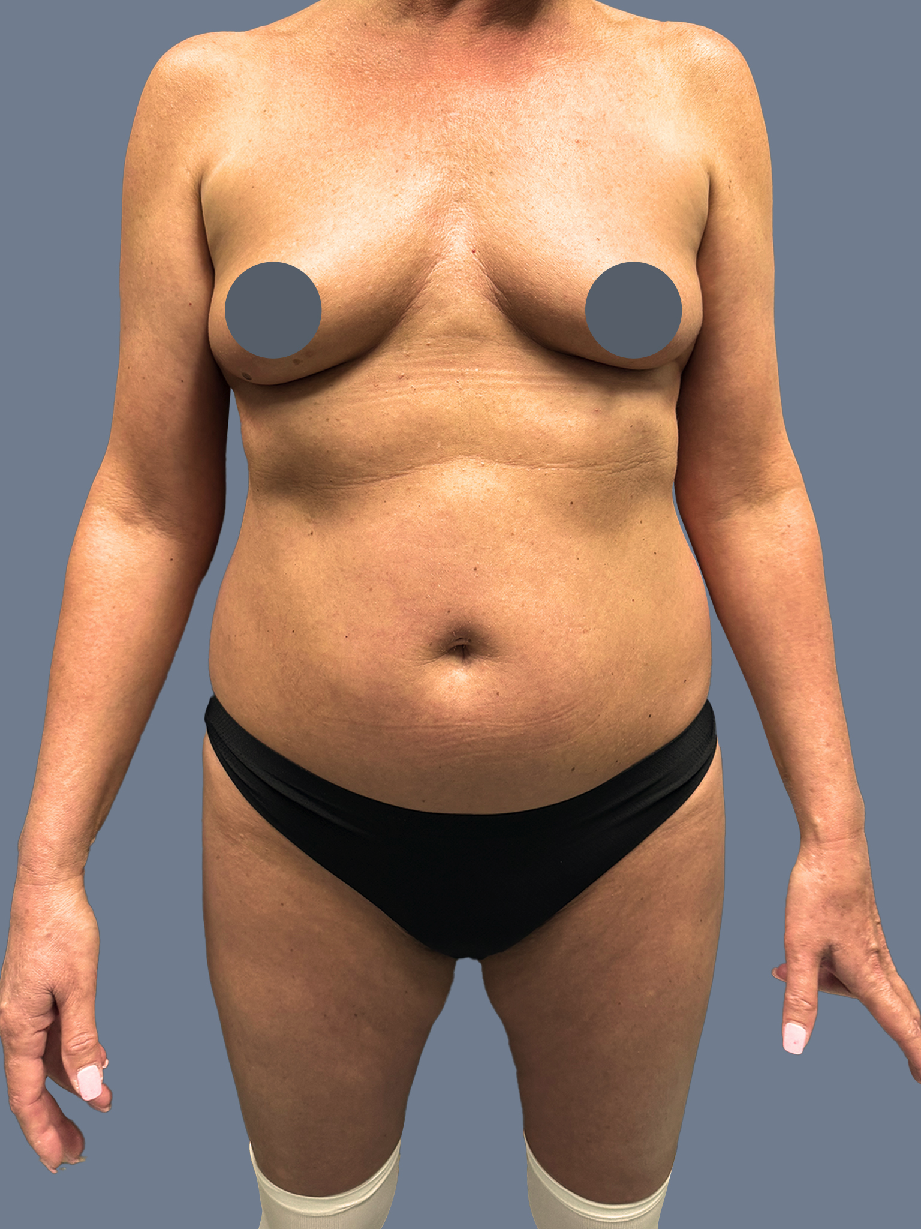 Case--9109-Lipo-360---8211--Breast-Augmentation | Before Lipo 360 - Breast Augmentation