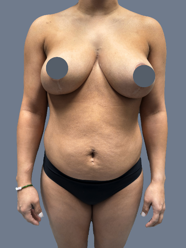 Case--3375-Lipo-360---8211--Tummy-Tuck-and-Breast-Augmentation-with-Lift | Before Breast