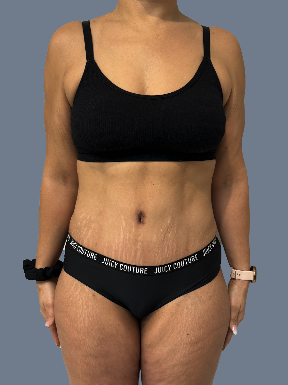 Case--3156-Lipo-360---8211--Tummy-Tuck | After Lipo 360 - Tummy Tuck