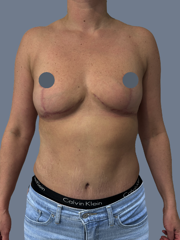 Case--3291-Breast-Lift | After Breast