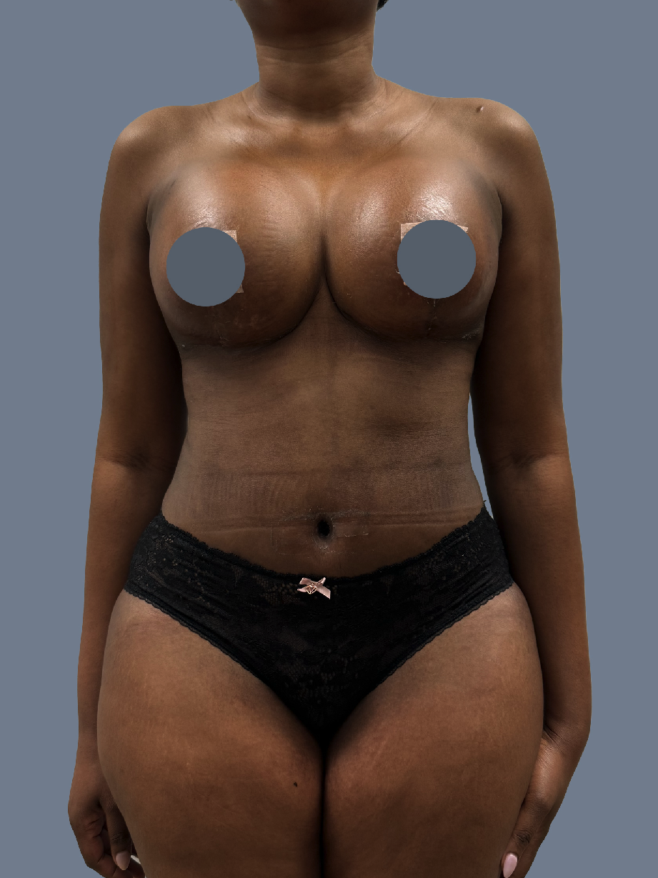 Case--5678-Breast-Lift---Augmentation | After Breast