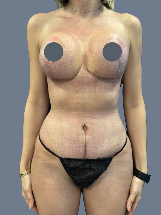 Case--1326-Lipo-360---8211--Tummy-Tuck-and-Breast-Augmentation-with-Lift | After Lipo 360 - Brazilian Butt Lift