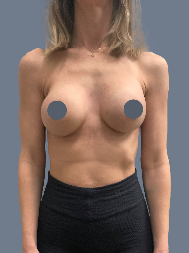 Case--2460-Breast-Augmentation | After Breast