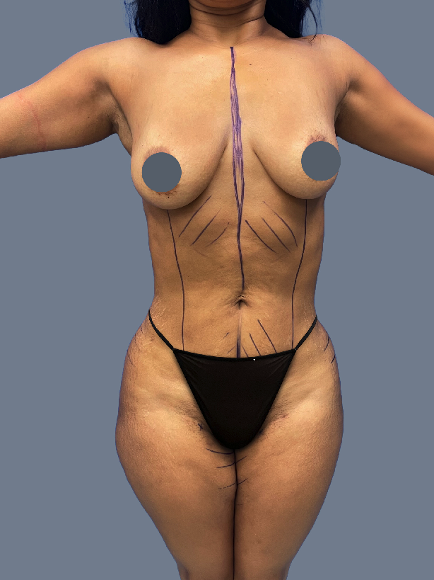 Case--6883-Lipo-360---8211--Revision-Brazilian-Butt-Lift | Before Lipo 360 - Brazilian Butt Lift