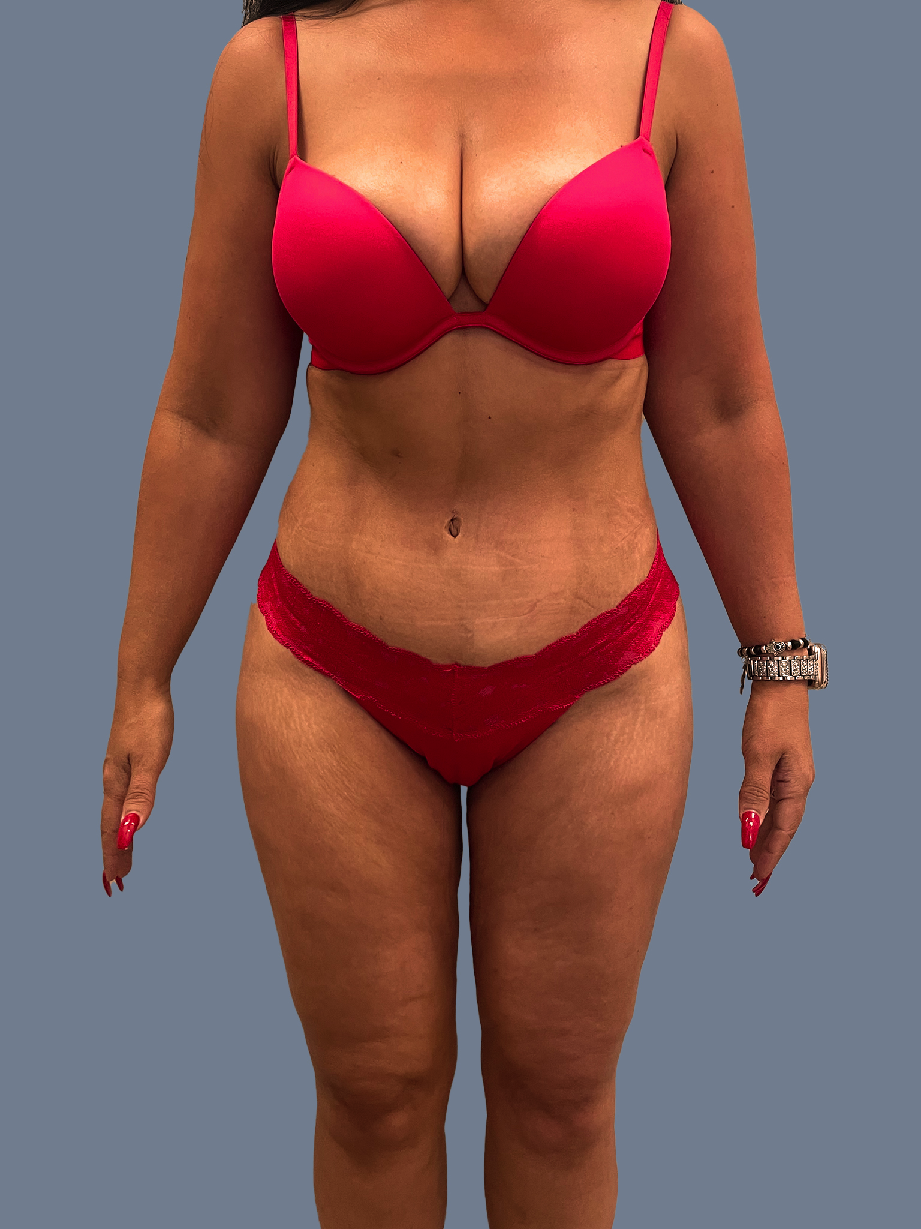 Case--9376-Lipo-360---8211--Thighs | After Lipo 360 - Thighs