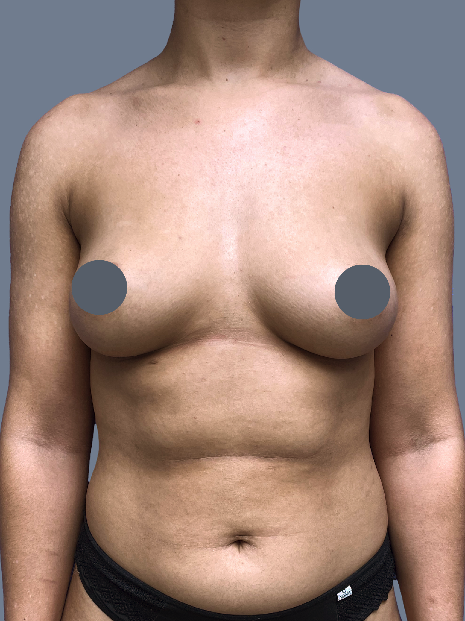 Case--8058-Breast-Augmentation | Before Breast