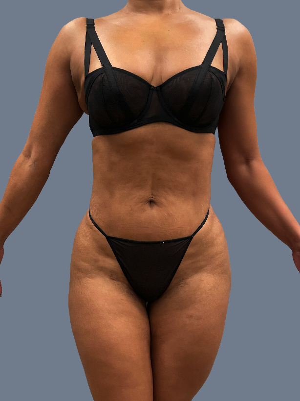 Case--6883-Lipo-360---8211--Revision-Brazilian-Butt-Lift | After Lipo 360 - Brazilian Butt Lift