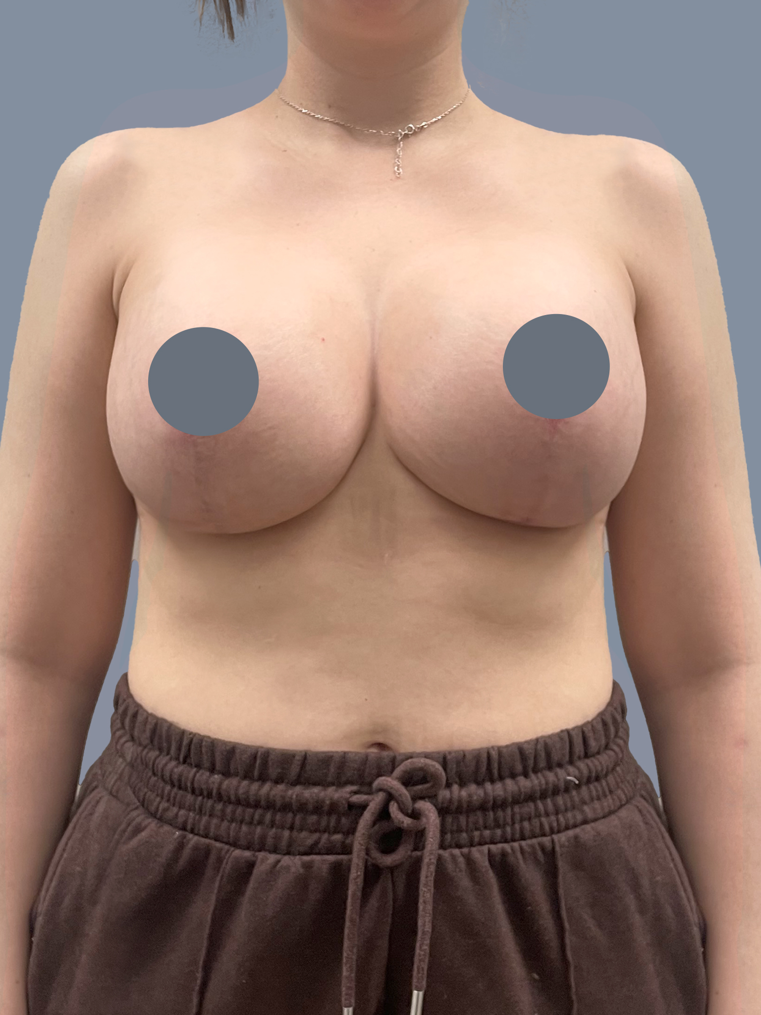 Case--7712-Breast-Lift---Augmentation | After Breast