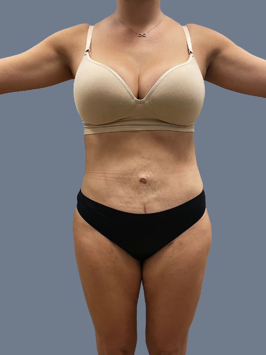 Case--5812-Lipo-360---8211--Brazilian-Butt-Lift | After Lipo 360 - Brazilian Butt Lift