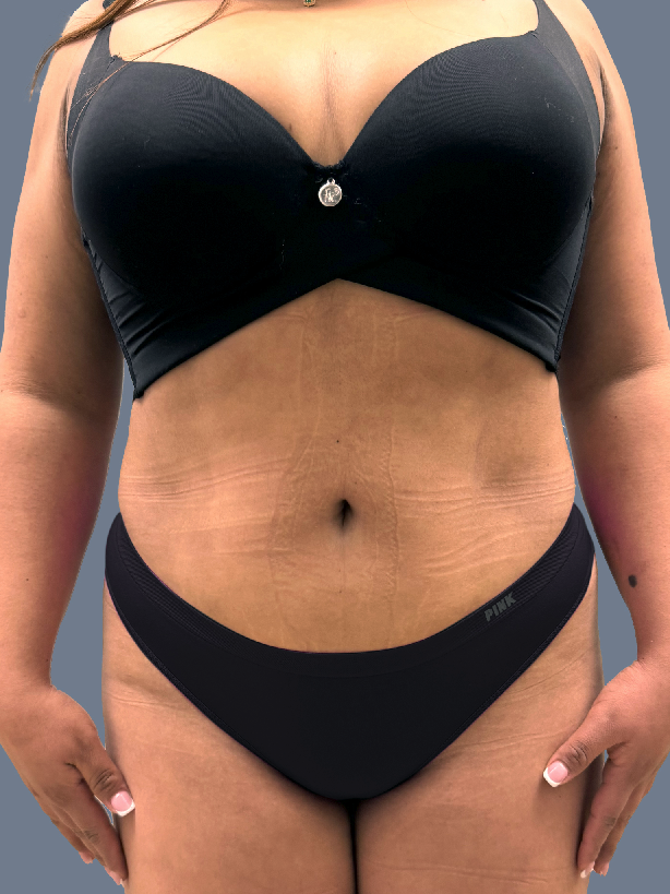 Case--9307-Lipo-360---8211--Brazilian-Butt-Lift | After Lipo 360 - Brazilian Butt Lift