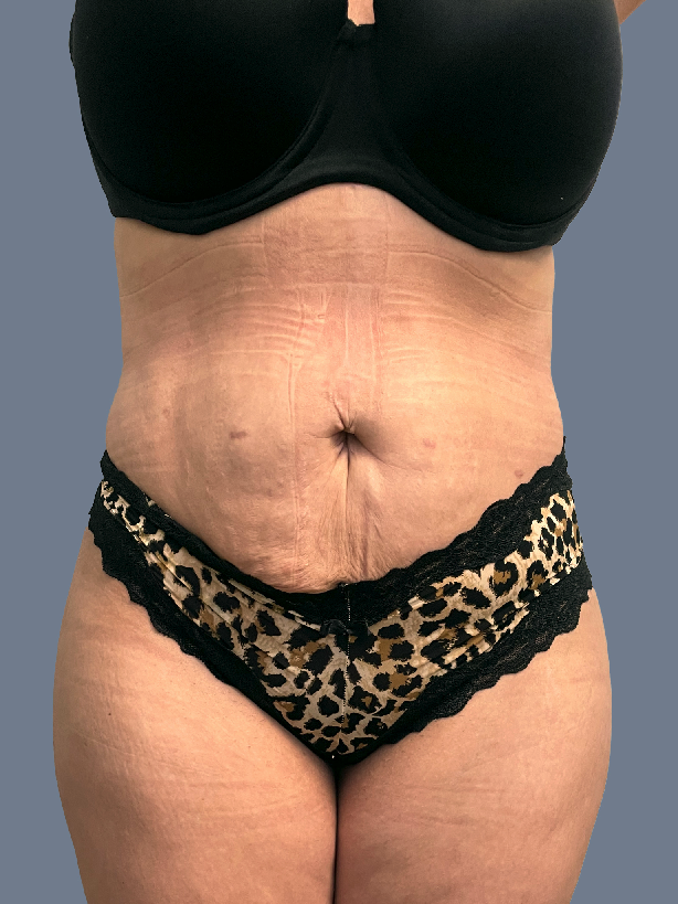 Case--6829-Lipo-360---8211--Brazilian-Butt-Lift-and-Arm-Liposuction | After Lipo 360 - Brazilian Butt Lift
