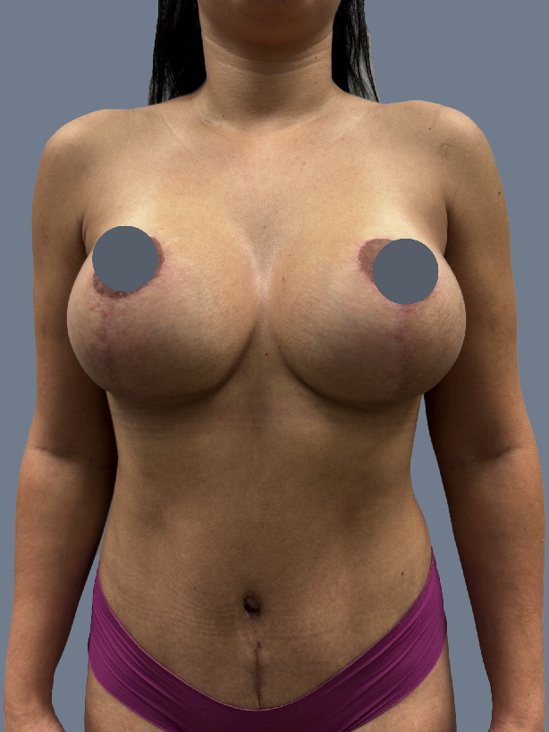 Case--8874-Breast-Augmentation-with-Lift | After Breast
