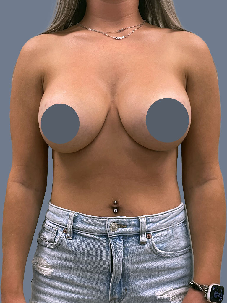 Case--8098-Breast-Augmentation | After Breast