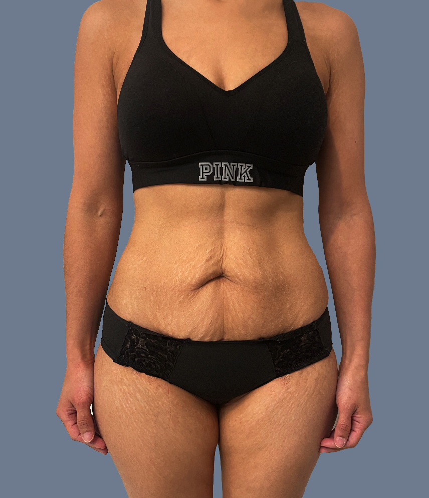 Case--9027-Lipo-360---8211--Tummy-Tuck | Before Lipo 360 - Tummy Tuck