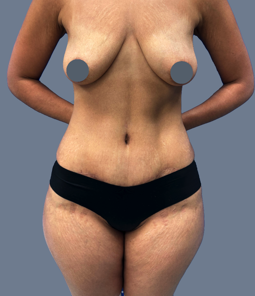 Case--9027-Lipo-360---8211--Tummy-Tuck | After Lipo 360 - Tummy Tuck