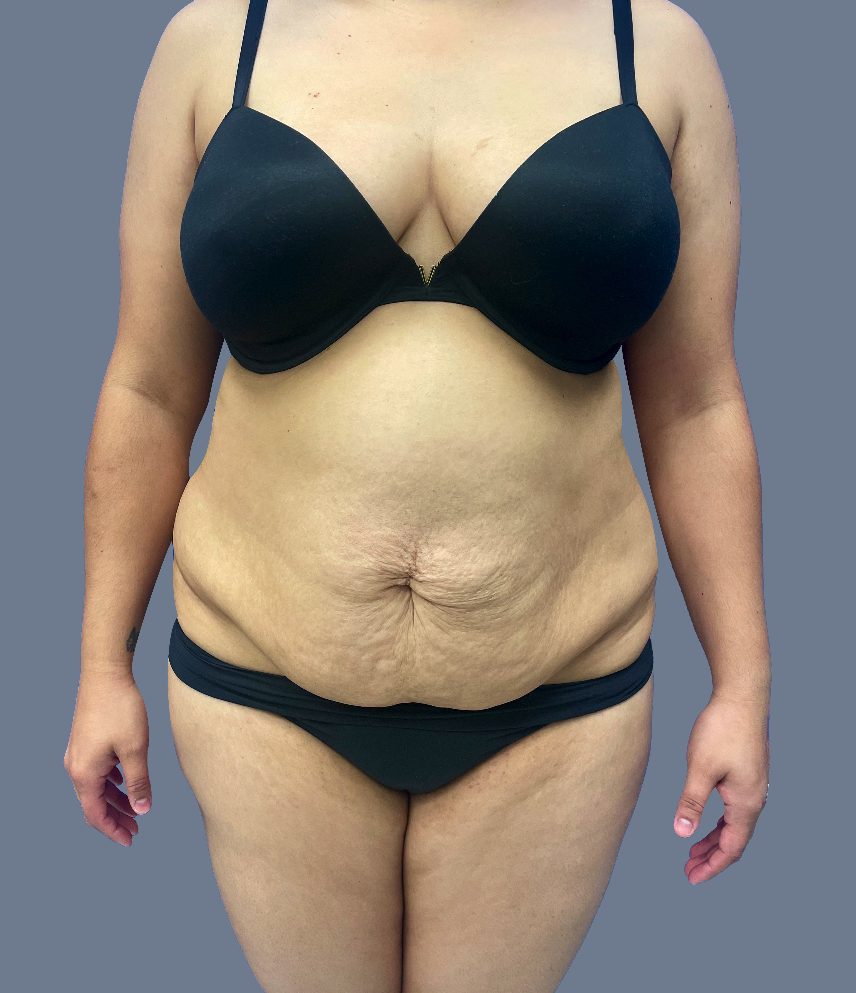 Case--8085-Lipo-360---8211--Tummy-Tuck | Before Lipo 360 - Tummy Tuck