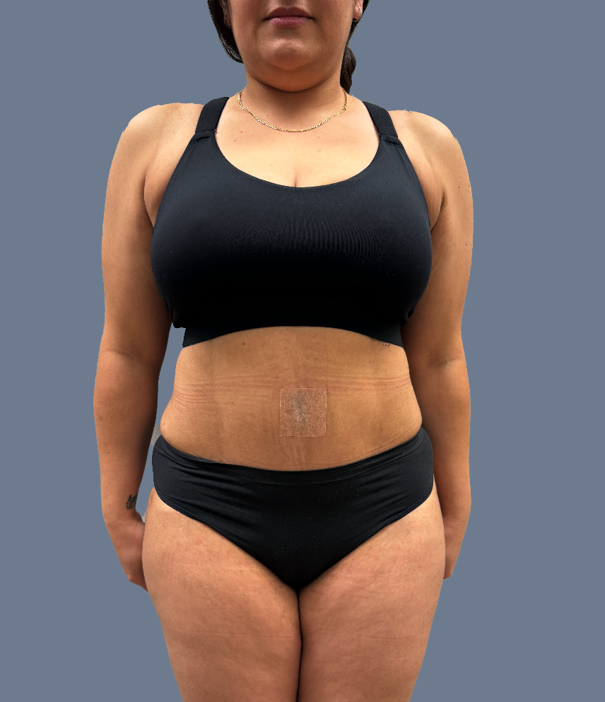 Case--8085-Lipo-360---8211--Tummy-Tuck | After Lipo 360 - Tummy Tuck