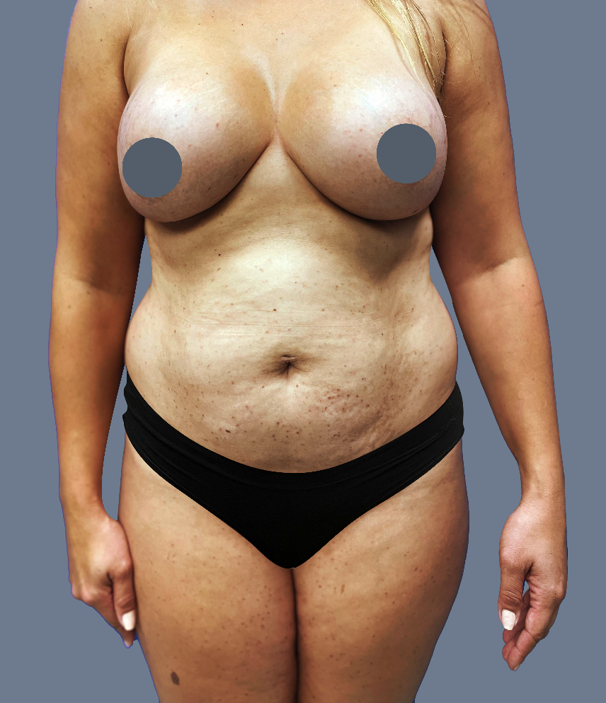 Case--7550-Lipo-360---8211--Brazilian-Butt-Lift-with-Arm-Liposuction | Before Lipo 360 - Brazilian Butt Lift