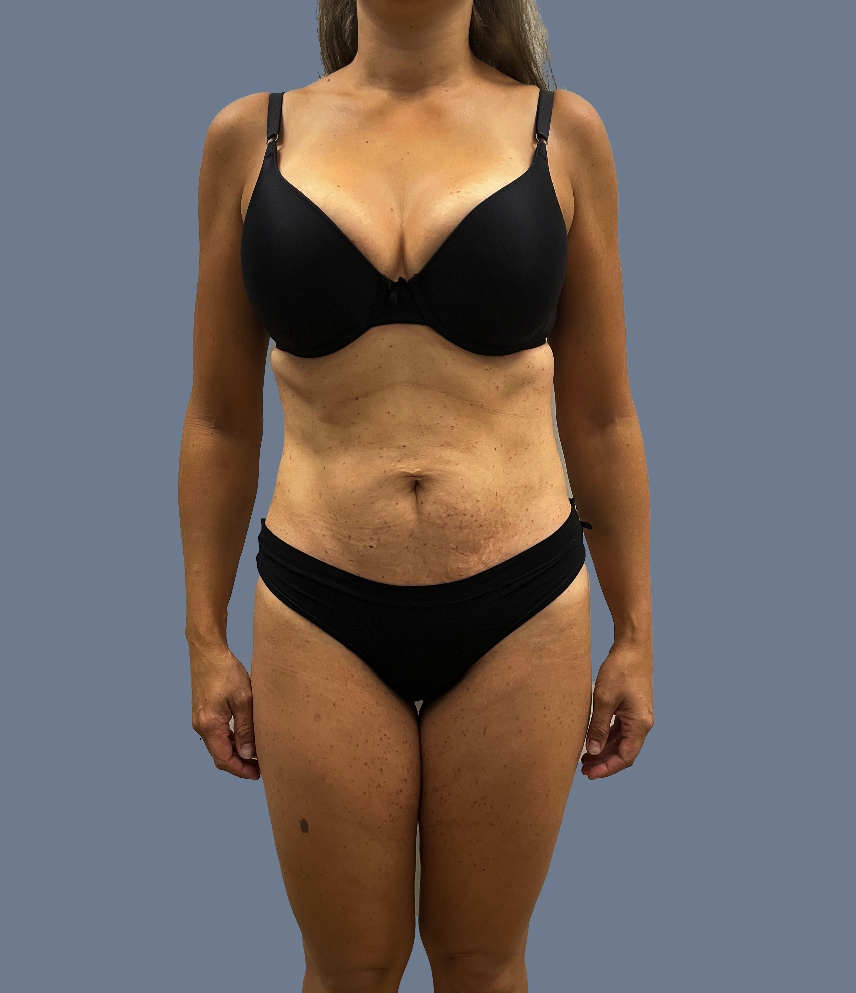 Case--7550-Lipo-360---8211--Brazilian-Butt-Lift-with-Arm-Liposuction | After Lipo 360 - Brazilian Butt Lift