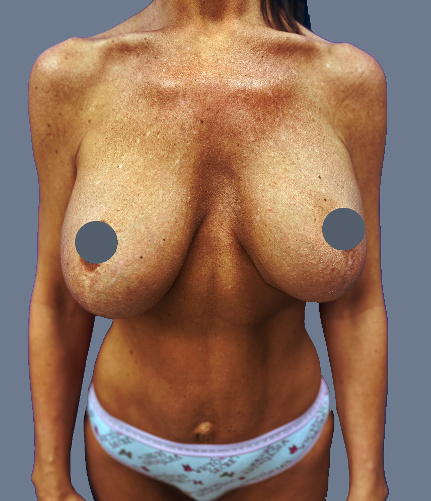 Case--6317-Breast-Revision | Before Breast