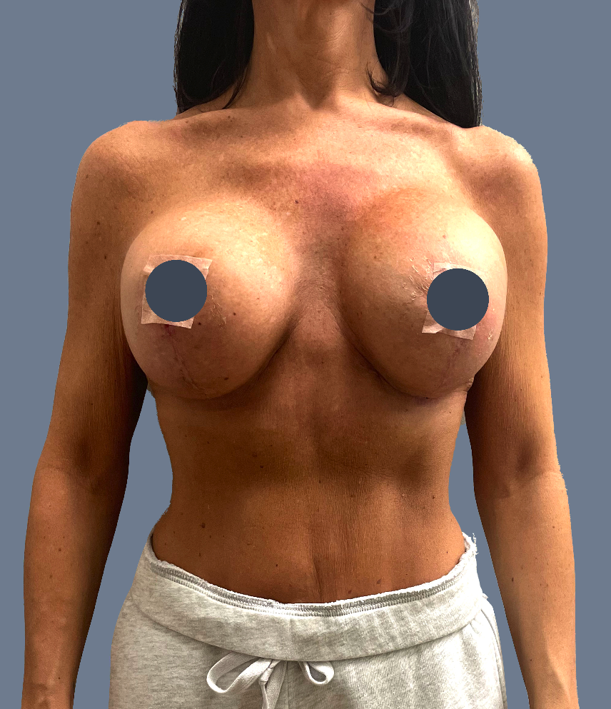 Case--6317-Breast-Revision | After Breast