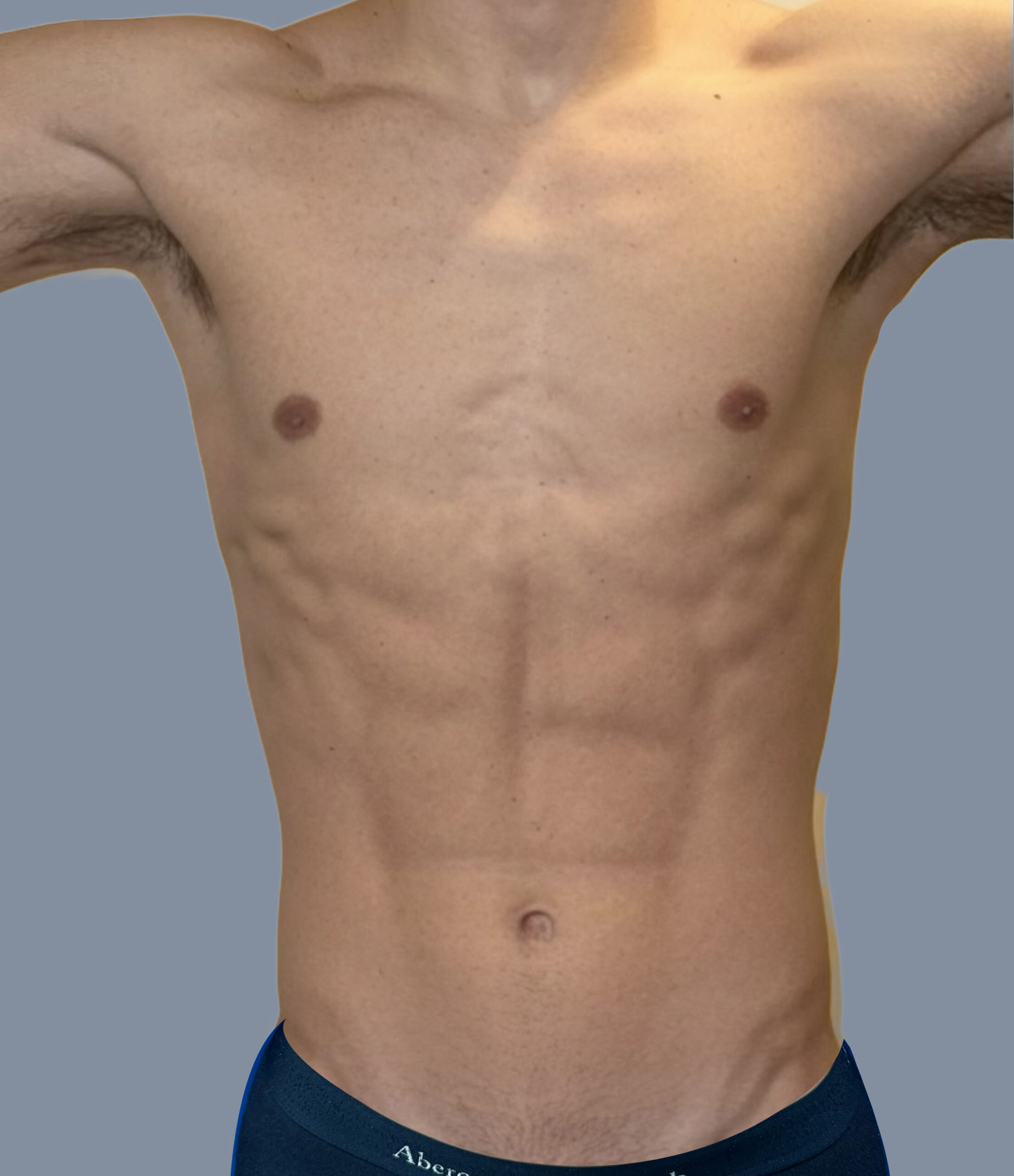 Case--4562 | After Male High Definition Liposuction
