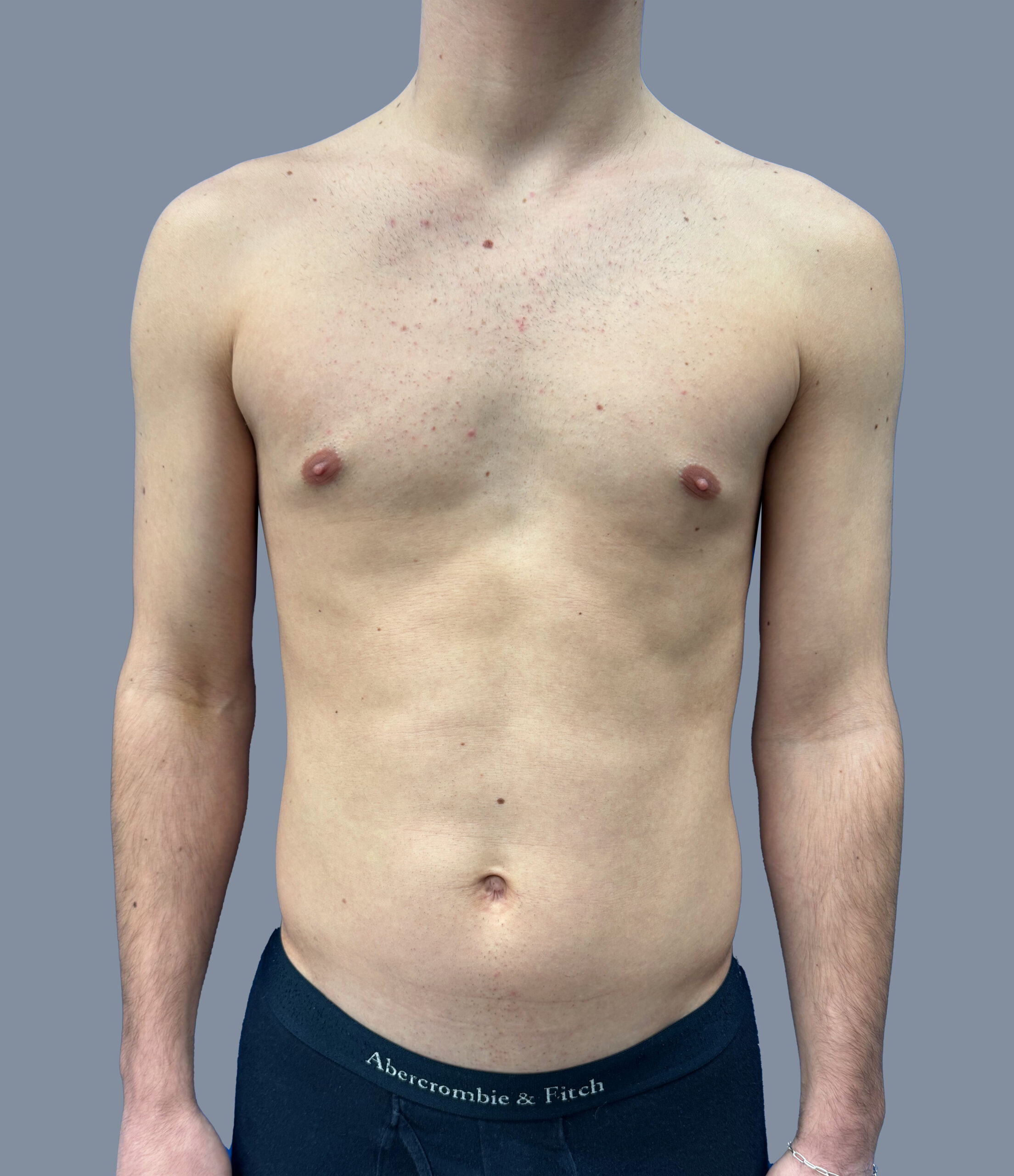 Case--4562 | Before Male High Definition Liposuction