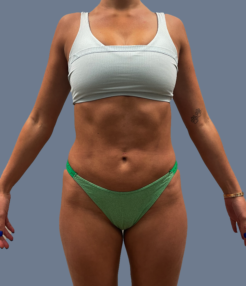 Case--4844-Female-High-Definition-Liposuction | Before Female High Definition Liposuction