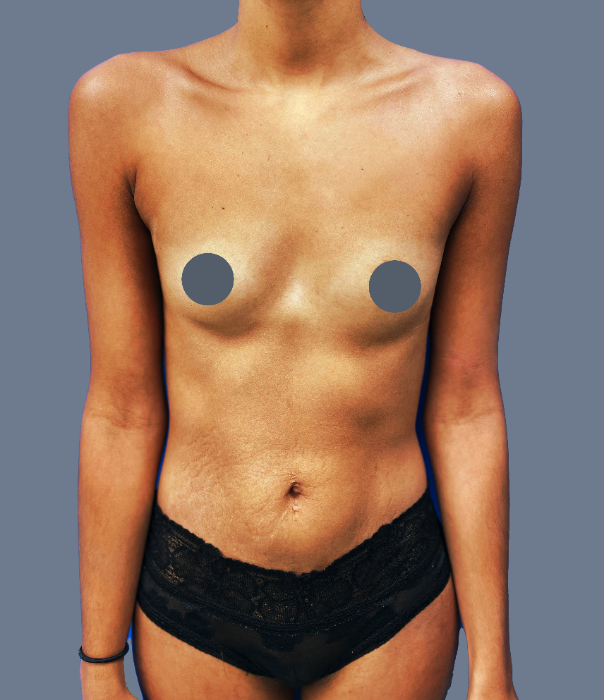 Case--9803-Breast-Augmentation | Before Breast