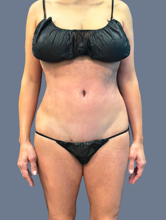 Case--7628-Lipo-360---8211--Brazilian-Butt-lift-and-Tummy-Tuck | After Lipo 360 - Brazilian Butt Lift