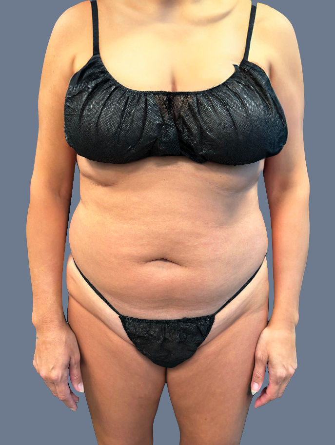 Case--7628-Lipo-360---8211--Brazilian-Butt-lift-and-Tummy-Tuck | Before Lipo 360 - Brazilian Butt Lift