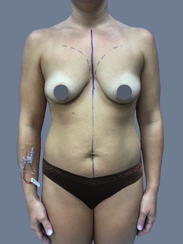Case--8284-Lipo-360---8211--Mini-Tummy-Tuck-and-Breast-Augmentation | Before Breast