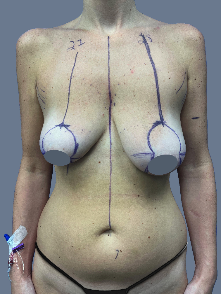Case--3880-Breast-Augmentation-with-Lift | Before Breast