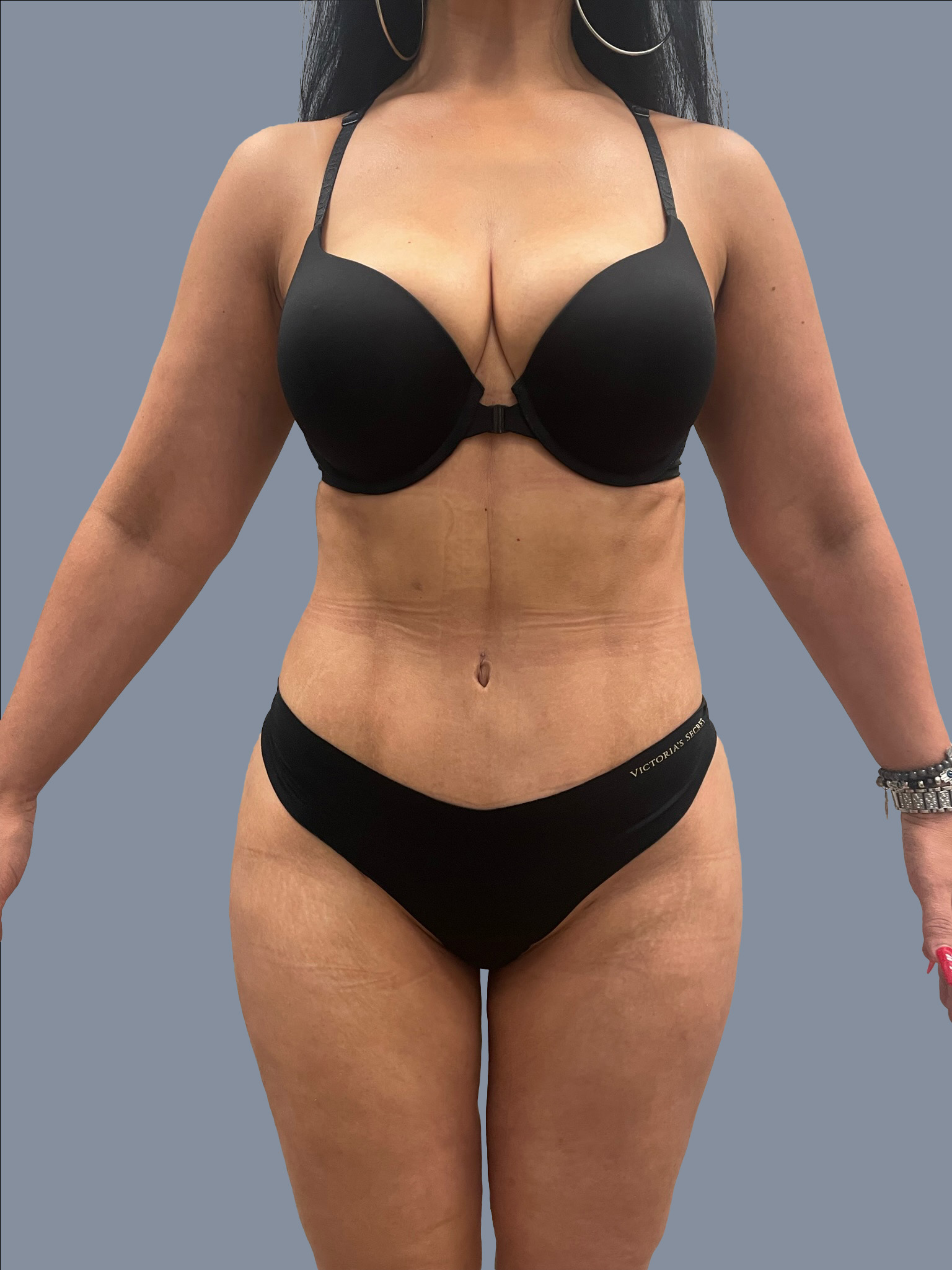 High Def Liposuction - Thighs
