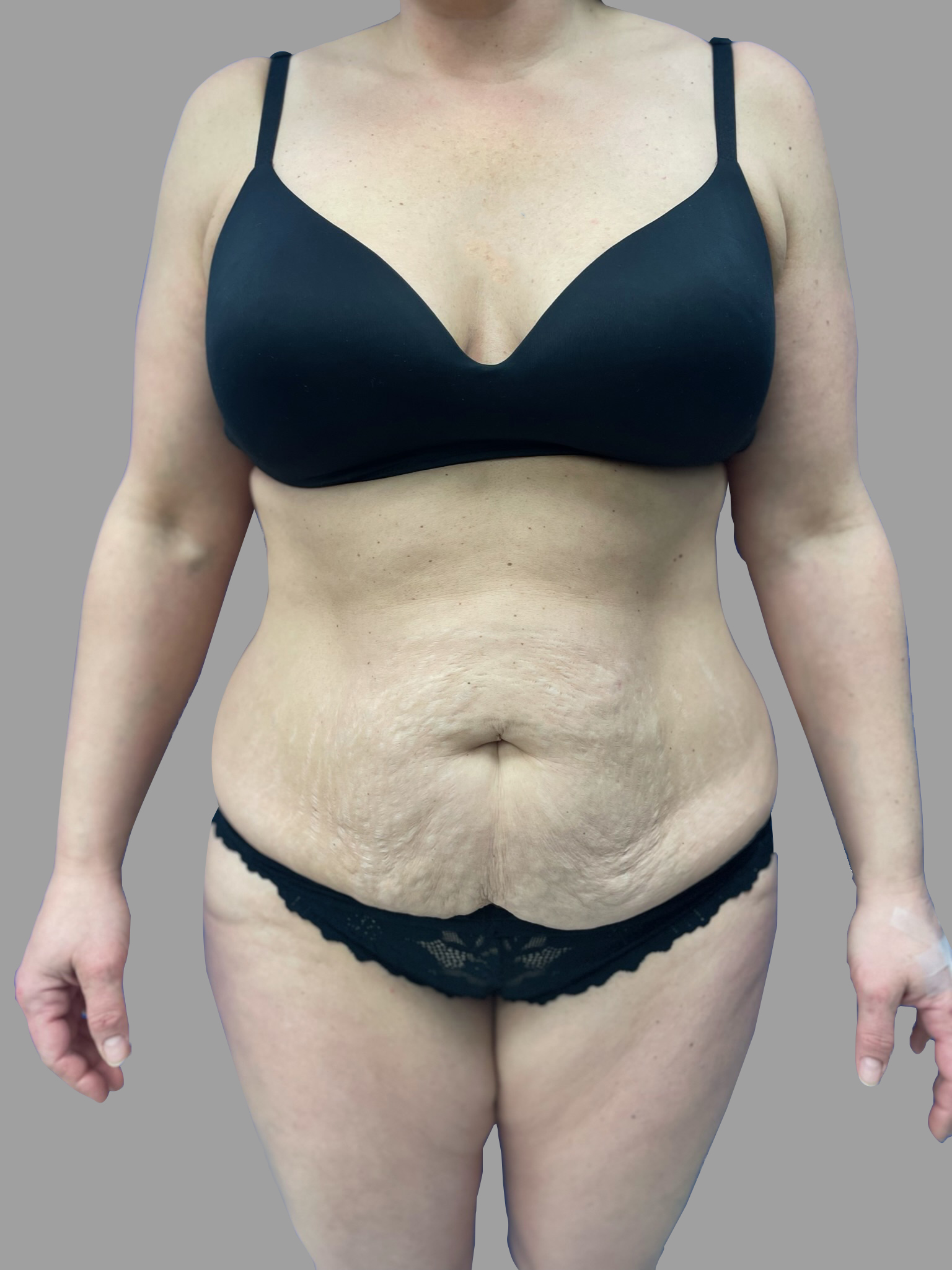 Lipo 360 & Tummy Tuck