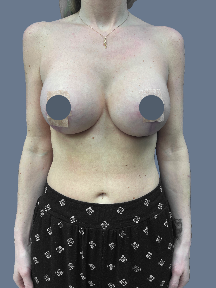 Case--3880-Breast-Augmentation-with-Lift | After Breast