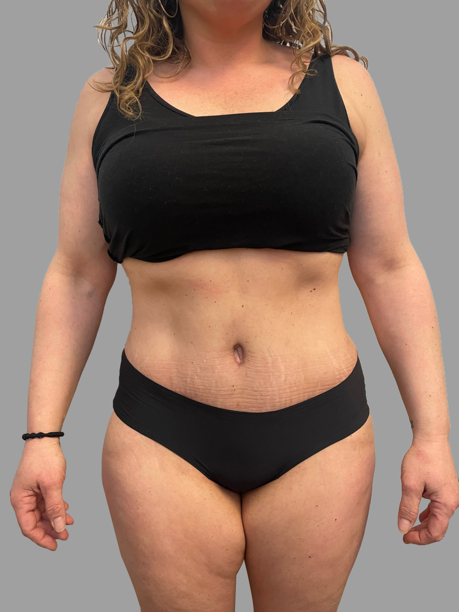 Lipo 360 & Tummy Tuck