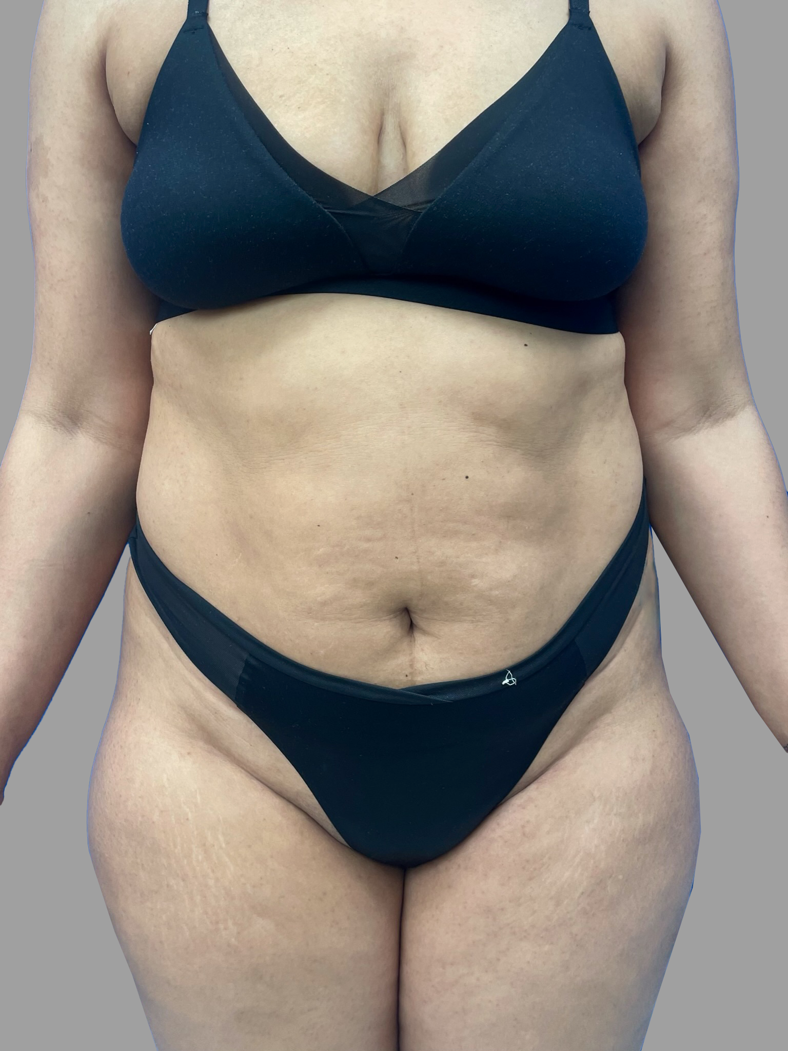 Lipo 360 and Tummy Tuck